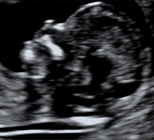 11-13週超音波検査