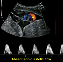 出生前サーベイランス